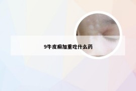 9牛皮癣加重吃什么药