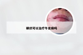 碘伏可以治疗牛皮癣吗