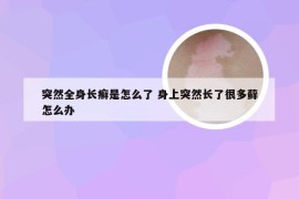 突然全身长癣是怎么了 身上突然长了很多藓怎么办