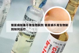 银屑病如果不用生物制剂 银屑病不用生物制剂如何治疗