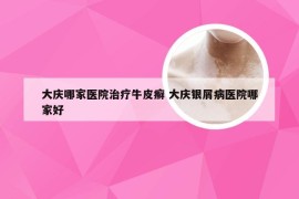 大庆哪家医院治疗牛皮癣 大庆银屑病医院哪家好