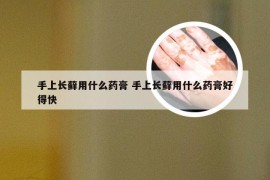 手上长藓用什么药膏 手上长藓用什么药膏好得快