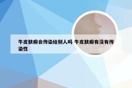 牛皮肤癣会传染给别人吗 牛皮肤癣有没有传染性