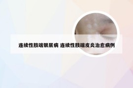 连续性肢端银屑病 连续性肢端皮炎治愈病例