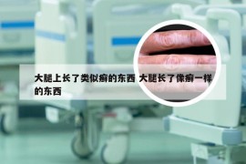 大腿上长了类似癣的东西 大腿长了像癣一样的东西