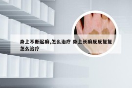 身上不断起癣,怎么治疗 身上长癣反反复复怎么治疗