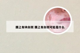 腰上有块白斑 腰上有白斑可能是什么