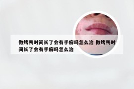 做烤鸭时间长了会有手癣吗怎么治 做烤鸭时间长了会有手癣吗怎么治