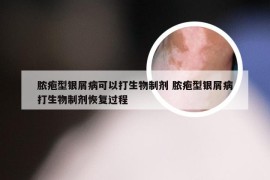 脓疱型银屑病可以打生物制剂 脓疱型银屑病打生物制剂恢复过程