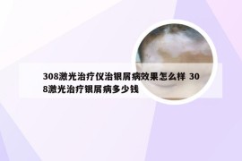 308激光治疗仪治银屑病效果怎么样 308激光治疗银屑病多少钱