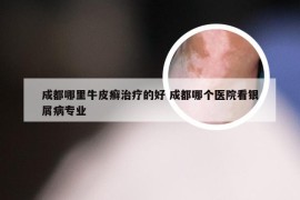 成都哪里牛皮癣治疗的好 成都哪个医院看银屑病专业