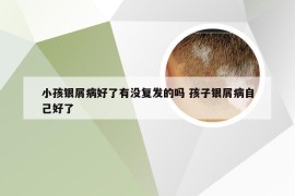 小孩银屑病好了有没复发的吗 孩子银屑病自己好了