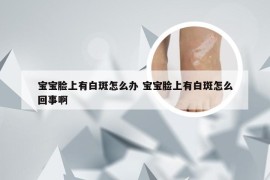 宝宝脸上有白斑怎么办 宝宝脸上有白斑怎么回事啊