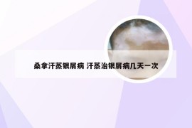 桑拿汗蒸银屑病 汗蒸治银屑病几天一次