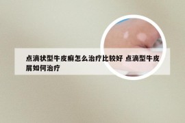 点滴状型牛皮癣怎么治疗比较好 点滴型牛皮屑如何治疗