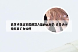 银屑病健康家园绿豆方是什么样的 银屑病吃绿豆真的有效吗