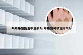 喝苹果醋能治牛皮癣吗 苹果醋可以治脚气吗