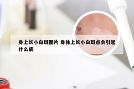 身上长小白斑图片 身体上长小白斑点会引起什么病