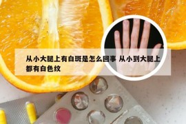 从小大腿上有白斑是怎么回事 从小到大腿上都有白色纹