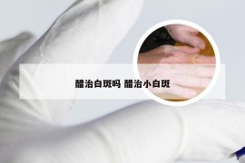 醋治白斑吗 醋治小白斑