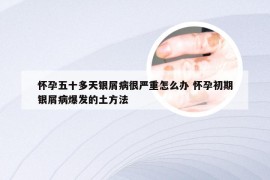 怀孕五十多天银屑病很严重怎么办 怀孕初期银屑病爆发的土方法