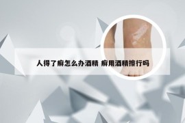 人得了癣怎么办酒精 癣用酒精擦行吗