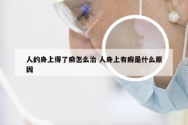 人的身上得了癣怎么治 人身上有癣是什么原因