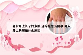 老公身上长了好多癣,还痒是怎么回事 男人身上长癣是什么原因