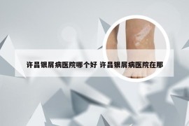 许昌银屑病医院哪个好 许昌银屑病医院在那