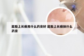 屁股上长癣用什么药膏好 屁股上长癣抹什么药膏