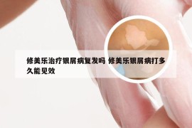 修美乐治疗银屑病复发吗 修美乐银屑病打多久能见效