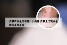 皮肤有白色斑块是什么向题 皮肤上出现白色斑块不疼不痒