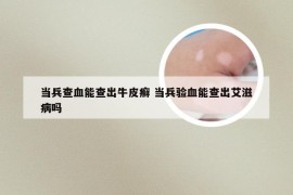 当兵查血能查出牛皮癣 当兵验血能查出艾滋病吗