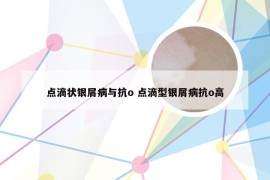 点滴状银屑病与抗o 点滴型银屑病抗o高