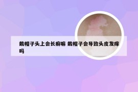 戴帽子头上会长癣嘛 戴帽子会导致头皮发痒吗