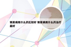 银屑病用什么药比较好 银屑病用什么药治疗最好