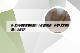 身上有顽固的癣用什么药擦最好 身体上的癣用什么药膏