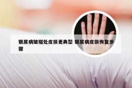 银屑病皱褶处皮损更典型 银屑病皮损恢复步骤