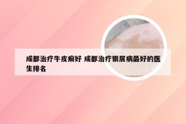 成都治疗牛皮癣好 成都治疗银屑病最好的医生排名