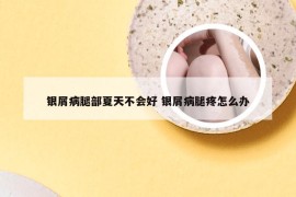 银屑病腿部夏天不会好 银屑病腿疼怎么办