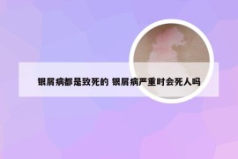 银屑病都是致死的 银屑病严重时会死人吗