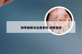 四季癣痒净含激素吗 四季癣膏