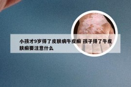 小孩才9岁得了皮肤病牛皮癣 孩子得了牛皮肤癣要注意什么