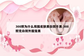 308照为什么周围皮肤黑白斑不黑 308照完白斑外圈变黑