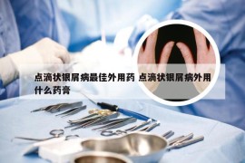 点滴状银屑病最佳外用药 点滴状银屑病外用什么药膏