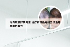 治白斑病好的方法 治疗白斑最好的方法治疗白斑的偏方