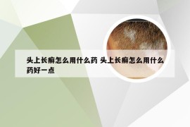 头上长癣怎么用什么药 头上长癣怎么用什么药好一点