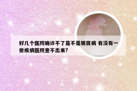 好几个医院确诊不了是不是银屑病 有没有一些疾病医院查不出来?