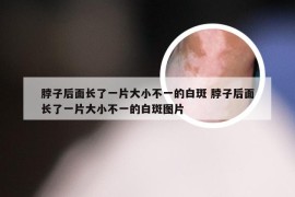 脖子后面长了一片大小不一的白斑 脖子后面长了一片大小不一的白斑图片