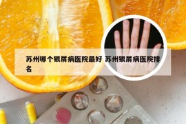 苏州哪个银屑病医院最好 苏州银屑病医院排名